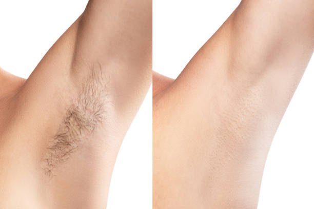 Split photo: female underarm before and after laser hair removal—dark, dense hair clear in “before” and perfectly smooth skin in “after”—proven results at NewLife Aesthetics, Raynes Park & Wimbledon, London.