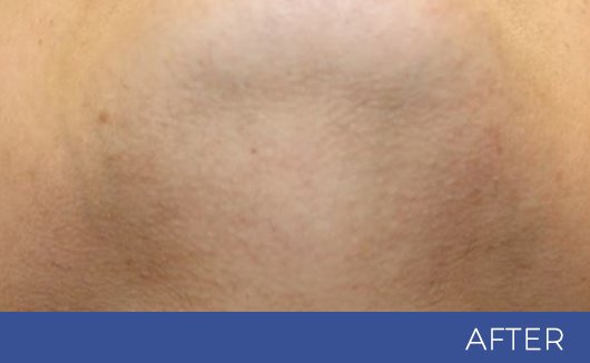 Female chin after laser hair removal—smooth, clear skin with no visible facial hair, irritation, or ingrowns at NewLife Aesthetics, Raynes Park & Wimbledon, London.