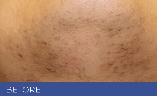 Female chin before laser hair removal—coarse, dark hair and ingrown hair visible on lower face prior to treatment at NewLife Aesthetics, Raynes Park & Wimbledon, London.