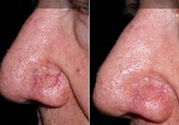Before and after results of laser capillary removal for nose redness and visible veins