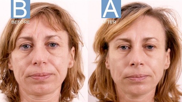 Exilis before and after face image