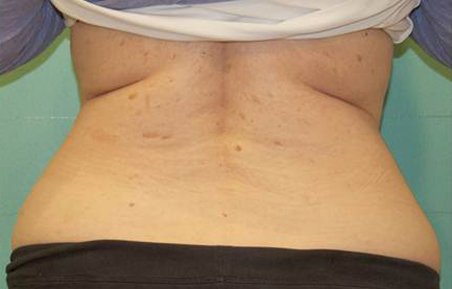 Exilis lovehandles after
