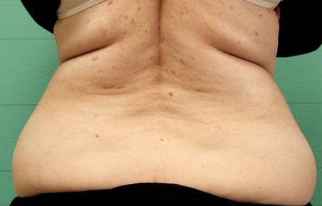 Exilis before