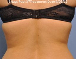 Exilis back after