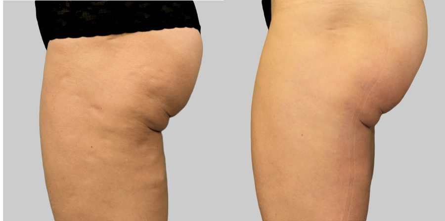 Exilis_Elite_After-thighs-female