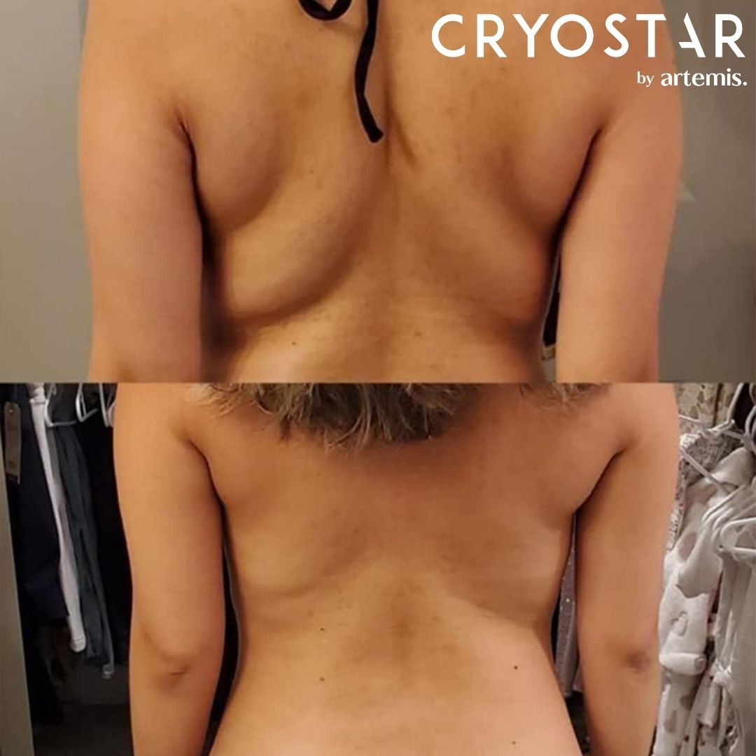 Back and bra fat before and after non-surgical fat reduction
