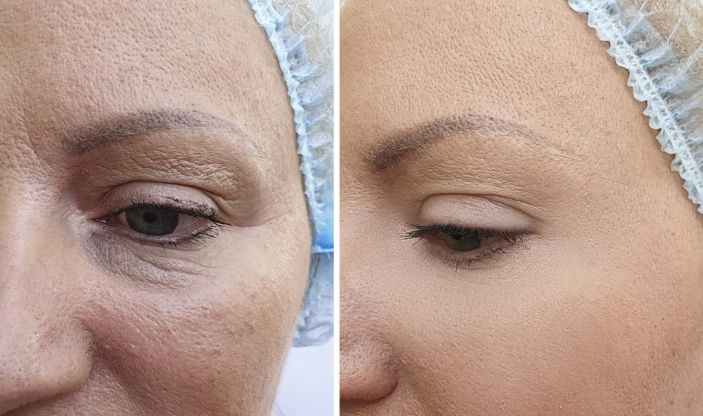 Before and after of woman’s facial wrinkles treated with mesotherapy at leading aesthetics clinic in Raynes Park, Wimbledon, London.