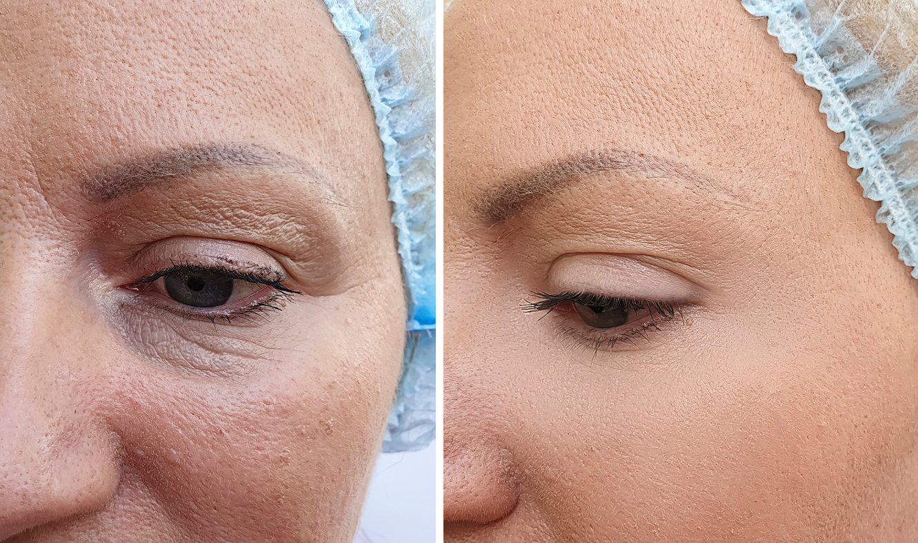 Before and after of woman’s facial wrinkles treated with mesotherapy at leading aesthetics clinic in Raynes Park, Wimbledon, London.