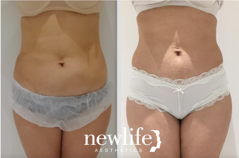 Radiofrequency _ shockwave