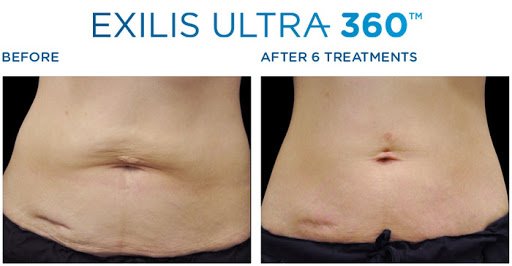 exilis stomach before and after