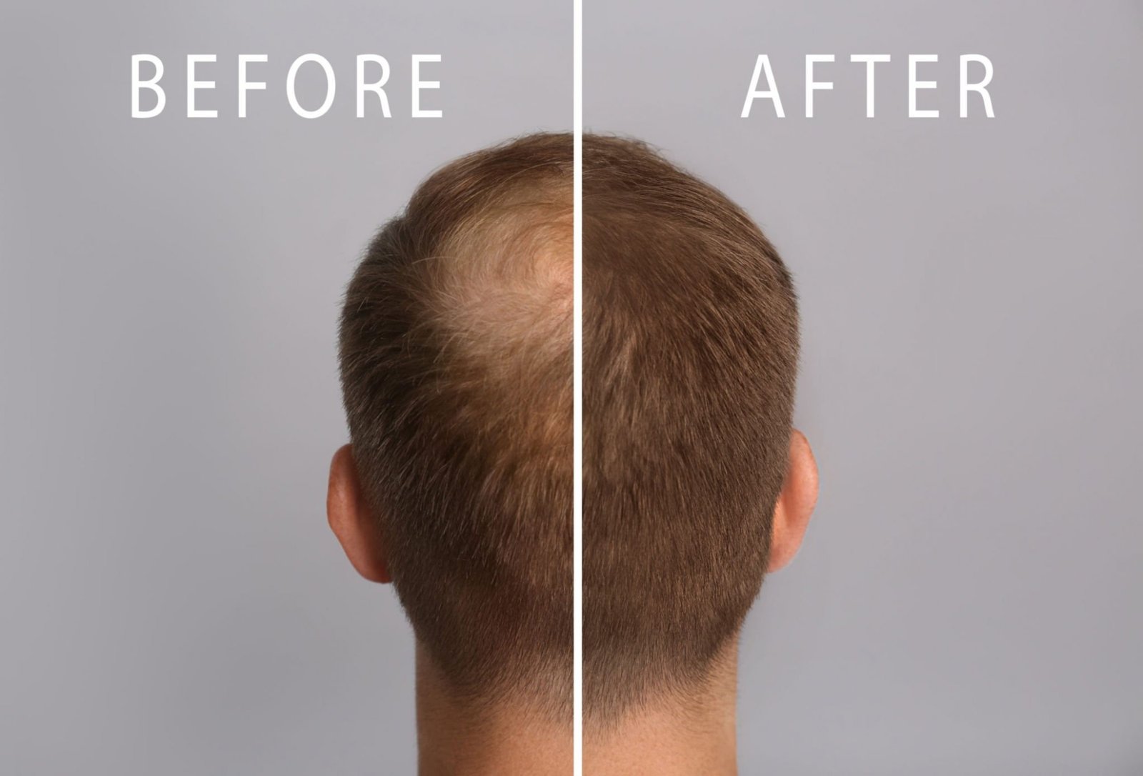 meso before and after for the hair loss