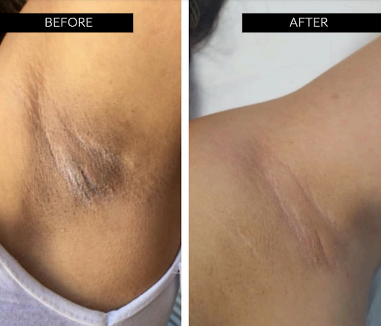 intimate skin brightening before and after on armpits