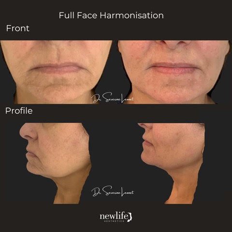 Full face harmonisation before and after at NewLife Aesthetics Raynes Park