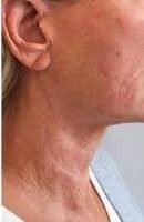 Facails_-HIFU-neck-before-and-after-